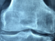 Osteoporosi, a Spoleto una giornata dedicata alla salute delle ossa